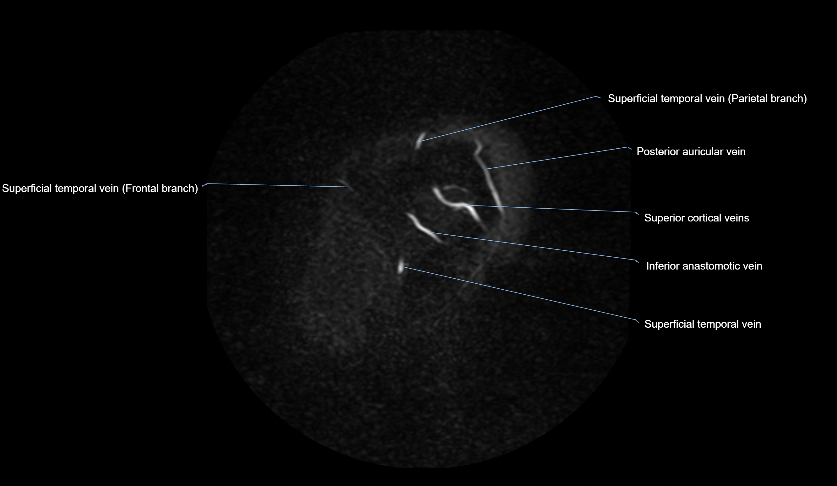 MRV brain sagittal anatomy 3T MRI labelledimages -00010.webp